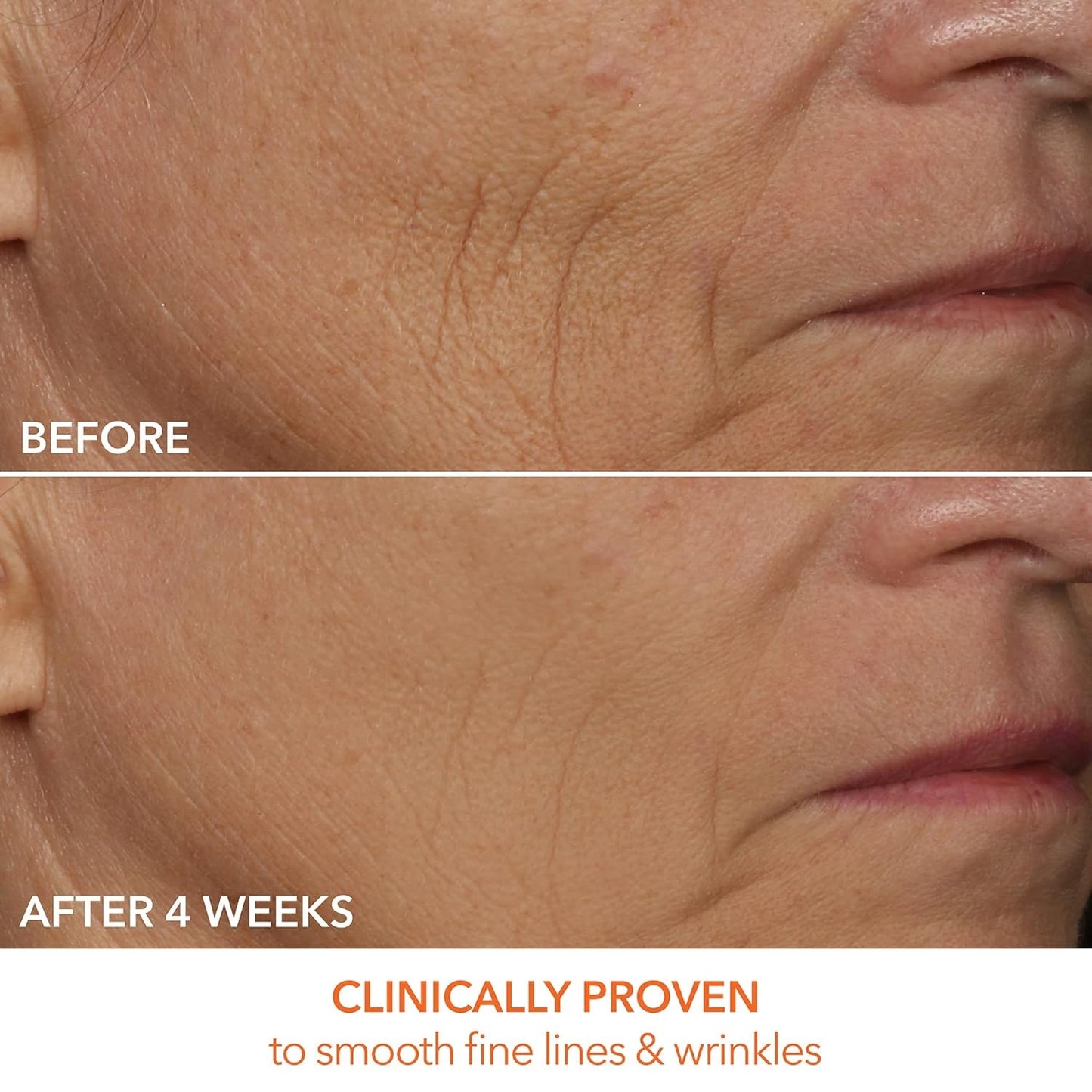Dr Dennis Gross DRx SpectraLite FaceWare Pro LED Mask - Before and After