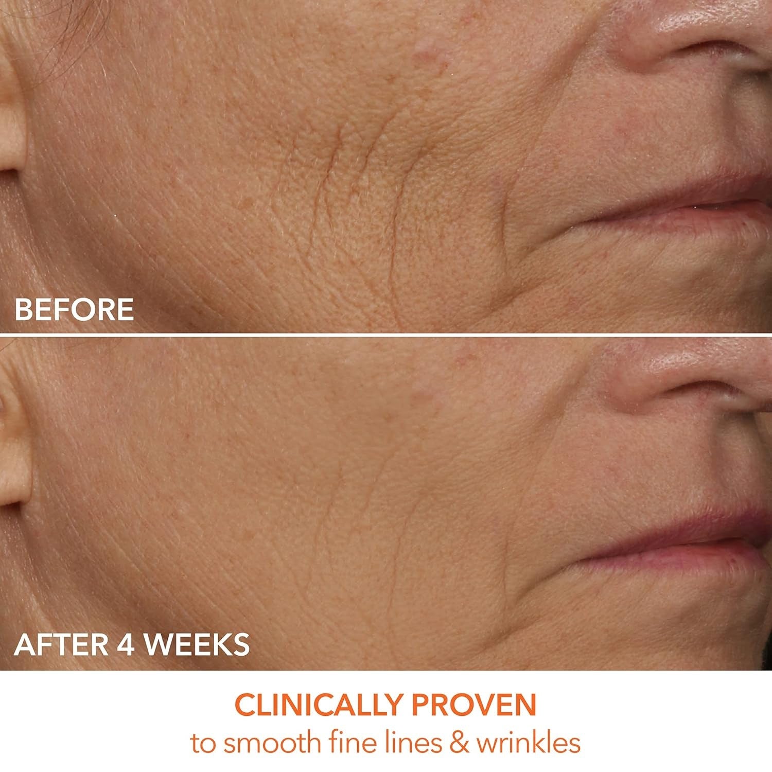 Dr Dennis Gross DRx SpectraLite FaceWare Pro LED Mask - Before and After